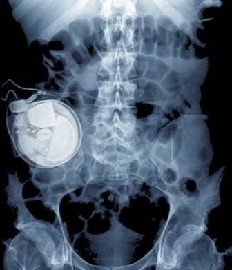 Intrathecal Ziconotide Long-Term Efficacy and Safety for Severe Chronic Pain Intrathecal Ziconotide Long-Term Efficacy and Safety for Severe Chronic Pain