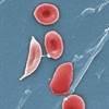 Is tPA Safe for Sickle Cell Patients in Acute Ischemic Stroke? Is tPA Safe for Sickle Cell Patients in Acute Ischemic Stroke?