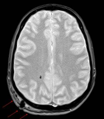 Accounting for Gender Differences in Concussion Diagnosis and Treatment Accounting for Gender Differences in Concussion Diagnosis and Treatment