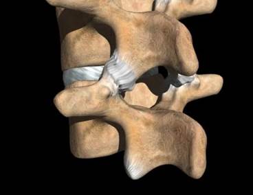 Radiofrequency Denervation for Facet Joint Arthropathy-Related Low Back Pain Radiofrequency Denervation for Facet Joint Arthropathy-Related Low Back Pain