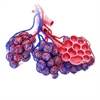 SLE Disease Flares Associated With Childhood Diffuse Alveolar Hemorrhage SLE Disease Flares Associated With Childhood Diffuse Alveolar Hemorrhage