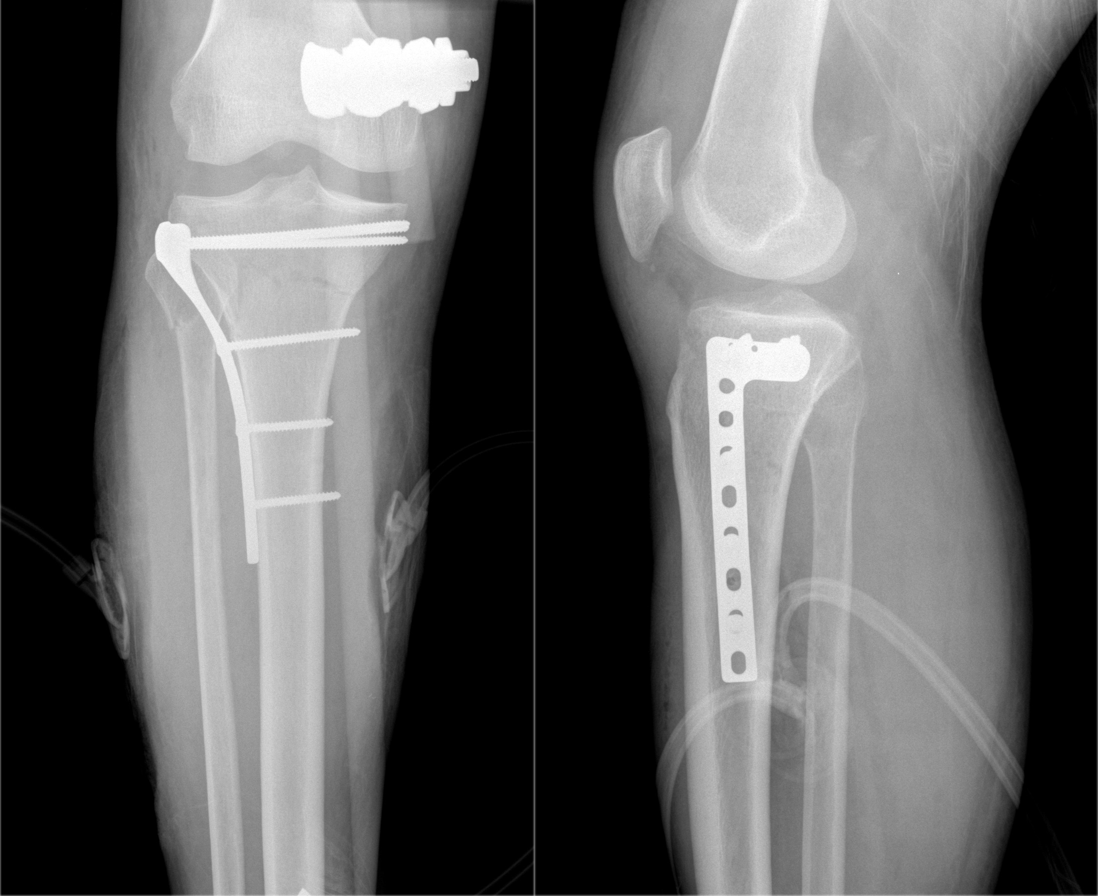 open fixation for le fort fracture