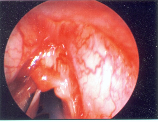 Congenital Cysts Involving Airway (Vallecular Cyst