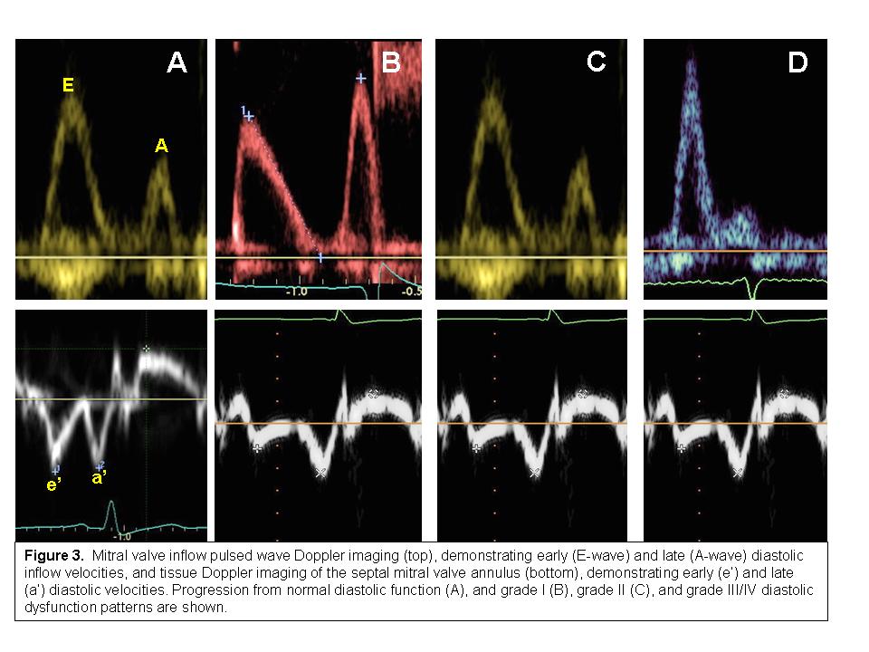 what-is-grade-ii-lv-diastolic-dysfunction-natural-resource-department