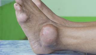 A collaborative approach is necessary to prevent hospitalizations associated with gout. A collaborative approach is necessary to prevent hospitalizations associated with gout.