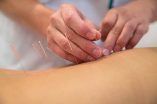 Some patients undergo acupuncture to treat arthritis. Some patients undergo acupuncture to treat arthritis.