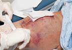 Oxycodone/Naloxone Beneficial After Total Knee Replacement Oxycodone/Naloxone Beneficial After Total Knee Replacement