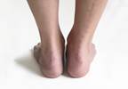 Do Doctors Often Miss Achilles Tendon Diagnosis? Do Doctors Often Miss Achilles Tendon Diagnosis?