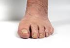 Rheumatoid Arthritis Linked to Neuropsychiatric Symptoms Rheumatoid Arthritis Linked to Neuropsychiatric Symptoms