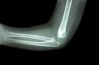 Some authors of a published study that claimed nitroglycerin might boost bone density in older women have asked that the study be retracted. Some authors of a published study that claimed nitroglycerin might boost bone density in older women have asked that the study be retracted.