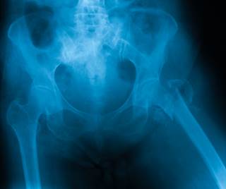Hip replacement should be delayed for 3 months after steroid injection. Hip replacement should be delayed for 3 months after steroid injection.