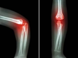 Rheumatoid arthritis was identified as a preoperative predictor of hospital readmission following total hip replacement. Rheumatoid arthritis was identified as a preoperative predictor of hospital readmission following total hip replacement.
