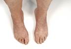 Can Foot Synovitis in RA Help Predict Unstable Long-Term Remission? Can Foot Synovitis in RA Help Predict Unstable Long-Term Remission?