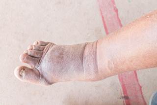 Are current nerve stimulation thresholds unreliable for diabetic neuropathy patients during regional anesthesia? Are current nerve stimulation thresholds unreliable for diabetic neuropathy patients during regional anesthesia?