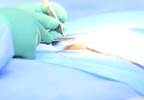 Nerve Blocks Reduce Acute and Chronic Pain After Inguinal Hernia Repair Nerve Blocks Reduce Acute and Chronic Pain After Inguinal Hernia Repair