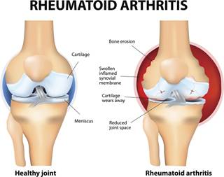 Adalimumab exerts its anti-inflammatory effects through 2 mechanisms Adalimumab exerts its anti-inflammatory effects through 2 mechanisms