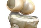Stem Cell Therapy for Osteoarthritis-Related Chronic Pain Stem Cell Therapy for Osteoarthritis-Related Chronic Pain