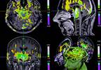 Understanding the Mechanisms of Depression With Neuroimaging Understanding the Mechanisms of Depression With Neuroimaging