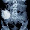 Intrathecal Ziconotide Long-Term Efficacy and Safety for Severe Chronic Pain Intrathecal Ziconotide Long-Term Efficacy and Safety for Severe Chronic Pain