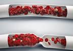 Mechanisms Common to Migraine, Venous Thromboembolism Mechanisms Common to Migraine, Venous Thromboembolism