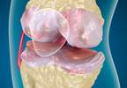 Knee Osteoarthritis, Metabolic Syndrome not Associated Knee Osteoarthritis, Metabolic Syndrome not Associated