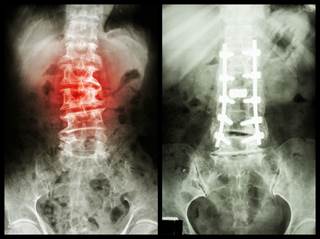 Minor structural progression occurs during 2 years of follow-up in early axial SpA in a small number of participants. Minor structural progression occurs during 2 years of follow-up in early axial SpA in a small number of participants.