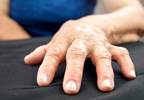 Lowering Methotrexate Dosage Not Supported in RA Patients Initiating Adalimumab Therapy Lowering Methotrexate Dosage Not Supported in RA Patients Initiating Adalimumab Therapy