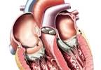 Opioid-Related Infectious Endocarditis Increasing In Young Women, Whites Opioid-Related Infectious Endocarditis Increasing In Young Women, Whites