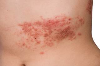 Researchers measured the presence and severity of pain and itch and impact on quality of life in patients with HZ. Researchers measured the presence and severity of pain and itch and impact on quality of life in patients with HZ.
