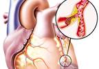 Assessing Risk for Cardiovascular Disease in Rheumatoid Arthritis Assessing Risk for Cardiovascular Disease in Rheumatoid Arthritis