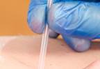 Treating Myofascial Pain With Trigger Point Injections Treating Myofascial Pain With Trigger Point Injections