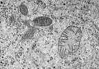 Metabolomic Deficiencies Characteristic of Chronic Fatigue Syndrome Metabolomic Deficiencies Characteristic of Chronic Fatigue Syndrome