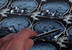 Association Between Cortical Thickness and Pain Duration Association Between Cortical Thickness and Pain Duration