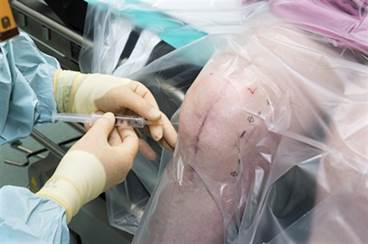 Addition of Peripheral Nerve Blocks Beneficial for TKA Addition of Peripheral Nerve Blocks Beneficial for TKA