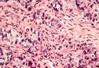 Rheumatoid, IBD Treatments and Risk of Breast Cancer Recurrence Rheumatoid, IBD Treatments and Risk of Breast Cancer Recurrence