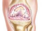Increasing The Rate of Knee Replacement Surgery With Decision Aid Increasing The Rate of Knee Replacement Surgery With Decision Aid