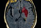 Risk of Stroke May Double in Women With Migraine History Risk of Stroke May Double in Women With Migraine History
