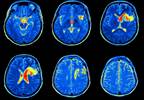 Evaluation of Cognition and Memory Function in Non-Neuropsychiatric SLE Evaluation of Cognition and Memory Function in Non-Neuropsychiatric SLE