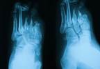 An Overview of Diabetic Peripheral Neuropathy An Overview of Diabetic Peripheral Neuropathy