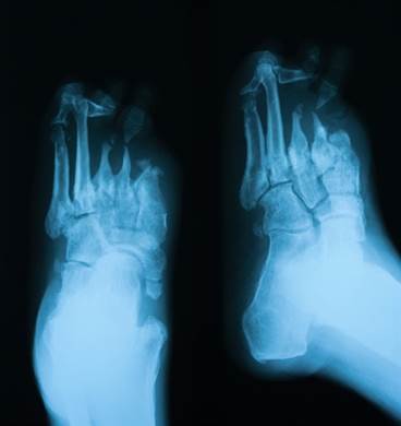 An Overview of Diabetic Peripheral Neuropathy An Overview of Diabetic Peripheral Neuropathy