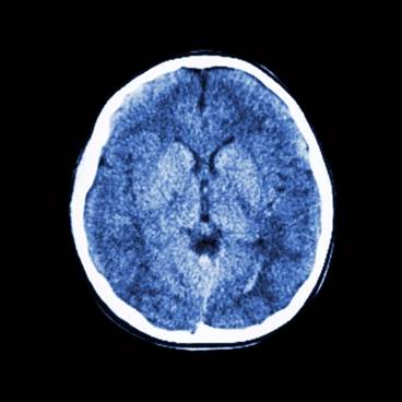 Differential Diagnosis for TBI, PTSD: a Case for Single-Photon Emission Computerized Tomography Differential Diagnosis for TBI, PTSD: a Case for Single-Photon Emission Computerized Tomography