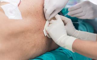 Avoiding the risks of cervical interlaminar epidural steroid injection, using a targeted epidural catheter. Avoiding the risks of cervical interlaminar epidural steroid injection, using a targeted epidural catheter.