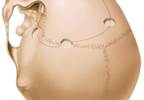 Difficulty in Evaluating Pharmacologic Interventions Following Craniotomy Difficulty in Evaluating Pharmacologic Interventions Following Craniotomy