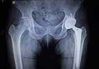 Benchmarking to Address Total Hip Arthroplasty-Related Pain? Benchmarking to Address Total Hip Arthroplasty-Related Pain?