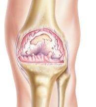Patients treated with CS b-Bioactive had statistically significantly less cartilage volume loss than patients who received celecoxib. Patients treated with CS b-Bioactive had statistically significantly less cartilage volume loss than patients who received celecoxib.