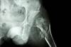 Fracture Risk in Children Predicted by New Bone Density Assessment Fracture Risk in Children Predicted by New Bone Density Assessment