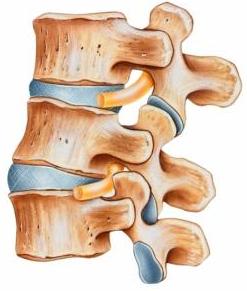 Alleviating Chronic Back Pain With Basivertebral Nerve Ablation