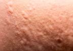 Hypersensitivity to NSAIDs: Risk Factors Hypersensitivity to NSAIDs: Risk Factors