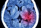 Migraine Is a Risk Factor for Stroke, Readmission After Surgery Migraine Is a Risk Factor for Stroke, Readmission After Surgery