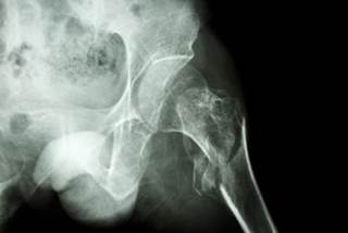 At 12 weeks after surgery for hip fracture, few have partial PTSD but more than half have fear of falling. At 12 weeks after surgery for hip fracture, few have partial PTSD but more than half have fear of falling.